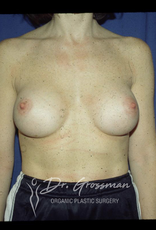 Transumbilical Breast Augmentation